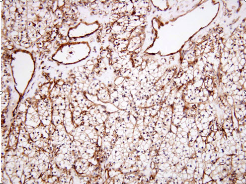 Paraffin embedded sections of human renal cell carcinoma tissue were incubated with anti-human Clusterin (1:100) for 2 hours at room temperature. Antigen retrieval was performed in 0.1M sodium citrate buffer and detected using Diaminobenzidine (DAB)