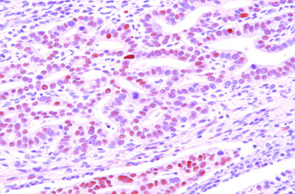 Paraffin embedded sections of human gastric cancer tissue were incubated with anti-human DACT3 (1:50) for 2 hours at room temperature. Antigen retrieval was performed in 0.1M sodium citrate buffer and detected using Diaminobenzidine (DAB)