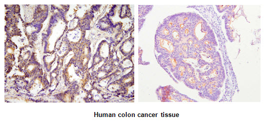Paraffin embedded sections of human colon cancer tissue were incubated with anti-human ACOT11 (1:100) for 2 hours at room temperature. Antigen retrieval was performed in 0.1M sodium citrate buffer and detected using Diaminobenzidine (DAB)