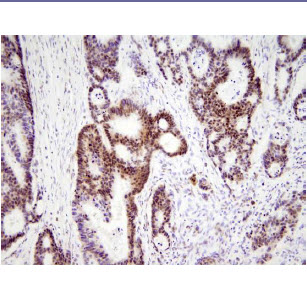 Paraffin embedded sections of human colon cancer tissue were incubated with anti-human HMGB1 (1:200) for 2 hours at room temperature. Antigen retrieval was performed in 0.1M sodium citrate buffer and detected using Diaminobenzidine (DAB)