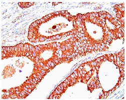 Paraffin embedded sections of human colon cancer tissue were incubated with anti-human Hsp60 (1:50) for 2 hours at room temperature. Antigen retrieval was performed in 0.1M sodium citrate buffer and detected using Diaminobenzidine (DAB)