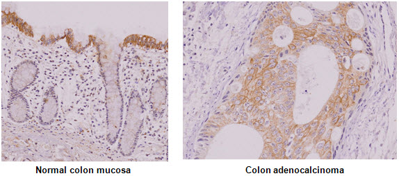Paraffin embedded sections of normal colon mucosa and colon adenocalcinoma tissue were incubated with anti-human IRF-5 antibody (1:50) for 2 hours at room temperature. Antigen retrieval was performed in 0.1M sodium citrate buffer and detected using Diaminobenzidine (DAB).