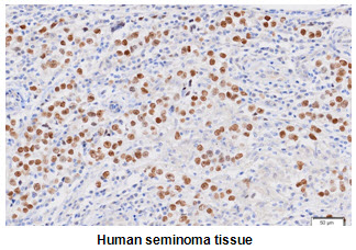 Paraffin embedded sections of human seminoma tissue were incubated with anti-human Nanog (1:50) for 2 hours at room temperature. Antigen retrieval was performed in 0.1M sodium citrate buffer and detected using Diaminobenzidine (DAB)