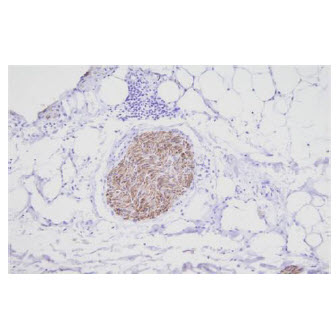 Paraffin embedded sections of human nerve tissue were incubated with anti-human PGP9.5 (1:100) for 2 hours at room temperature. Antigen retrieval was performed in 0.1M sodium citrate buffer and detected using Diaminobenzidine (DAB).