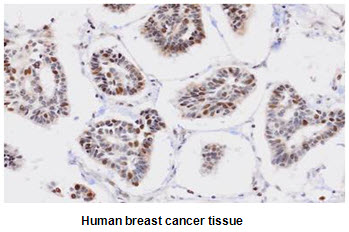 Paraffin embedded sections of human breast cancer tissue were incubated with anti-human PPM1G (1:50) for 2 hours at room temperature. Antigen retrieval was performed in 0.1M sodium citrate buffer and detected using Diaminobenzidine (DAB)