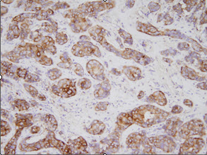 Human gastric cancer tissues were incubated with anti-human TPD52L1 (1:200) for o/n at room temperature. Slides were then washed in PBS, and were incubated in avidin biosystem anti-rabbit labeled polymer for 30 min at RT. Enzyme detection was performed with DAB chromogen.