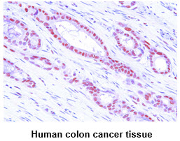 Paraffin embedded sections of human colon cancer tissue were incubated with anti-human MAT2A (1:50) for 2 hours at room temperature. Antigen retrieval was performed in 0.1M sodium citrate buffer and detected using Diaminobenzidine (DAB)