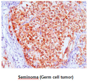 Paraffin embedded sections of Seminoma (Germ cell tumor) tissue were incubated with anti-human FKBP4 (1:50) for 2 hours at room temperature. Antigen retrieval was performed in 0.1M sodium citrate buffer and detected using Diaminobenzidine (DAB)