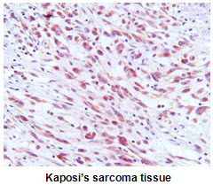 Paraffin embedded sections of Kaposi's sarcoma tissue were incubated with anti-ORF73/HHV8 (1:50) for 2 hours at room temperature. Antigen retrieval was performed in 0.1M sodium citrate buffer and detected using Diaminobenzidine (DAB)