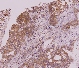 Paraffin embedded sections of colorectal cancer tissue were incubated with anti-human MINCLE antibody (1:50) for 2 hours at room temperature. Antigen retrieval was performed in 0.1M sodium citrate buffer and detected using Diaminobenzidine (DAB).