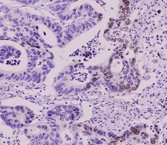 Paraffin embedded sections of colorectal cancer tissue were incubated with anti-human SUMO2/3 antibody (1:50) for 2 hours at room temperature. Antigen retrieval was performed in 0.1M sodium citrate buffer and detected using Diaminobenzidine (DAB).