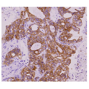 Paraffin embedded sections of colorectal cancer tissue were incubated with anti-human KRT18 antibody (1:50) for 2 hours at room temperature. Antigen retrieval was performed in 0.1M sodium citrate buffer and detected using Diaminobenzidine (DAB).