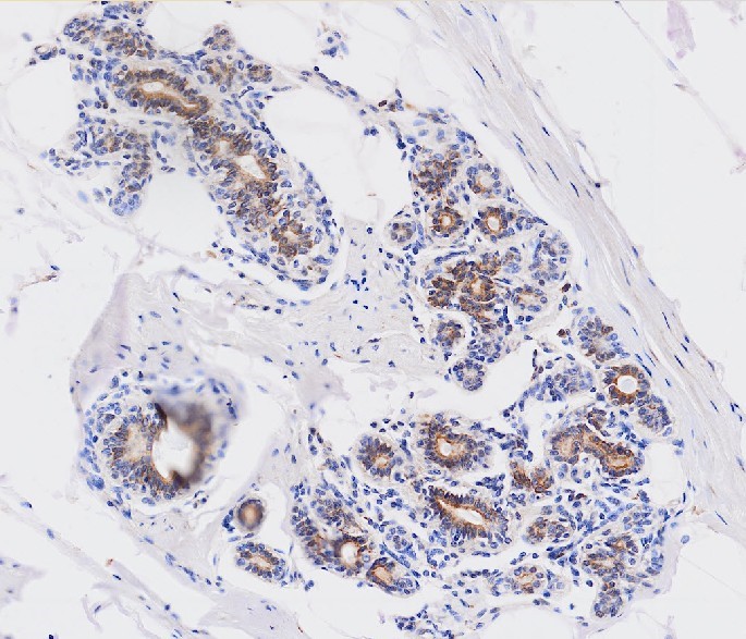 Paraffin embedded sections of human breast cancer tissue were incubated with anti-human Wnt3a (1:50) for 2 hours at room temperature. Antigen retrieval was performed in 0.1M sodium citrate buffer and detected using Diaminobenzidine (DAB)